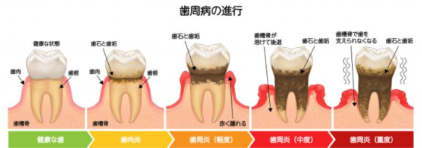 歯周病の進行